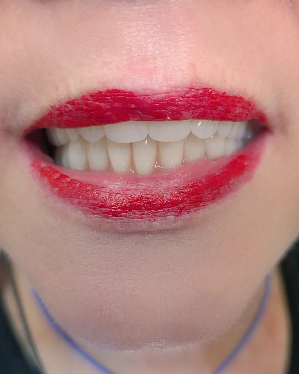 Elkészült BPS fogsor viselés közben