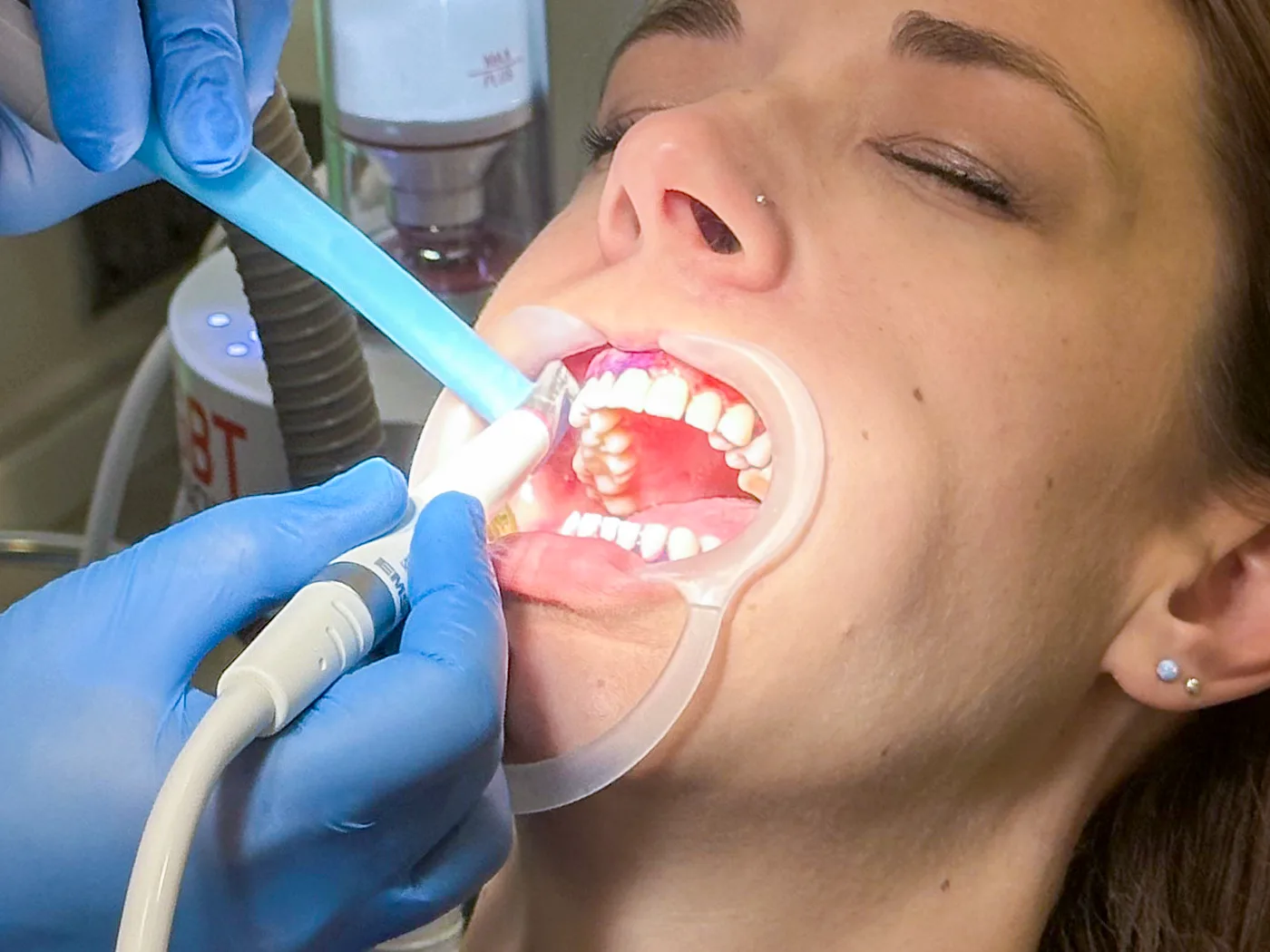 AIRFLOW® kezelés: a dentálhigiénikus meleg vizes porsugárral tisztítja a fogakat
