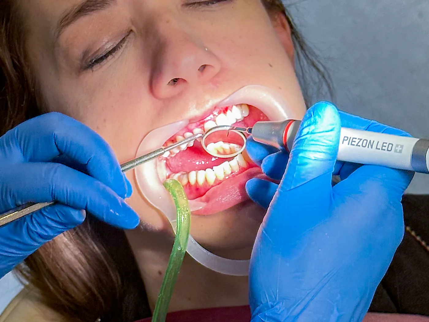PIEZON® fogkőeltávolítás: a dentálhigiénikus a PIEZON LED kézidarabbal és szájtükörrel dolgozik
