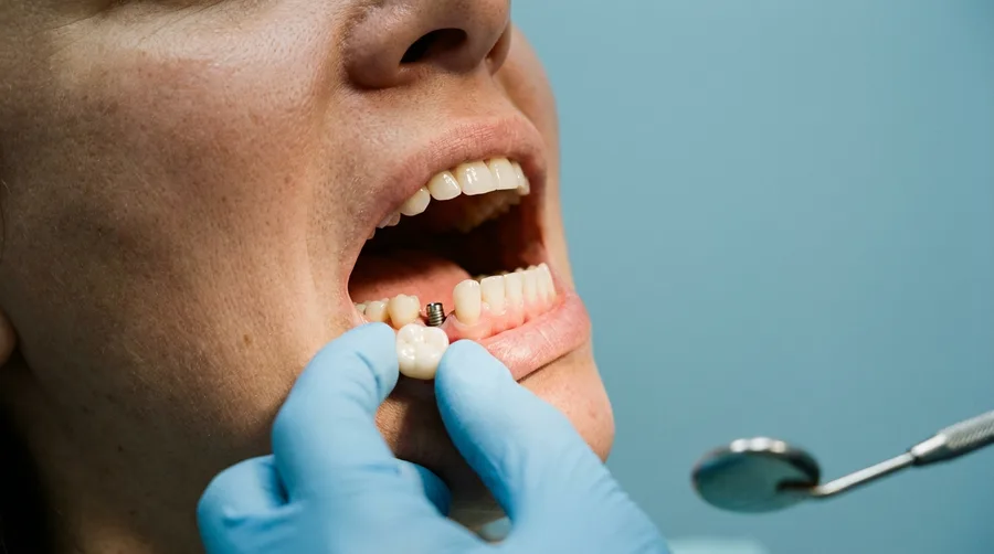 Felépítmény és végleges fogpótlás: a korona az implantátum fölött, felhelyezés előtt
