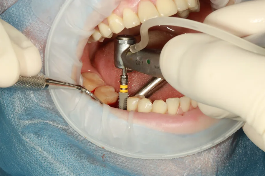 Implantátumbehelyezés: az implantátum becsavarása az állcsontba