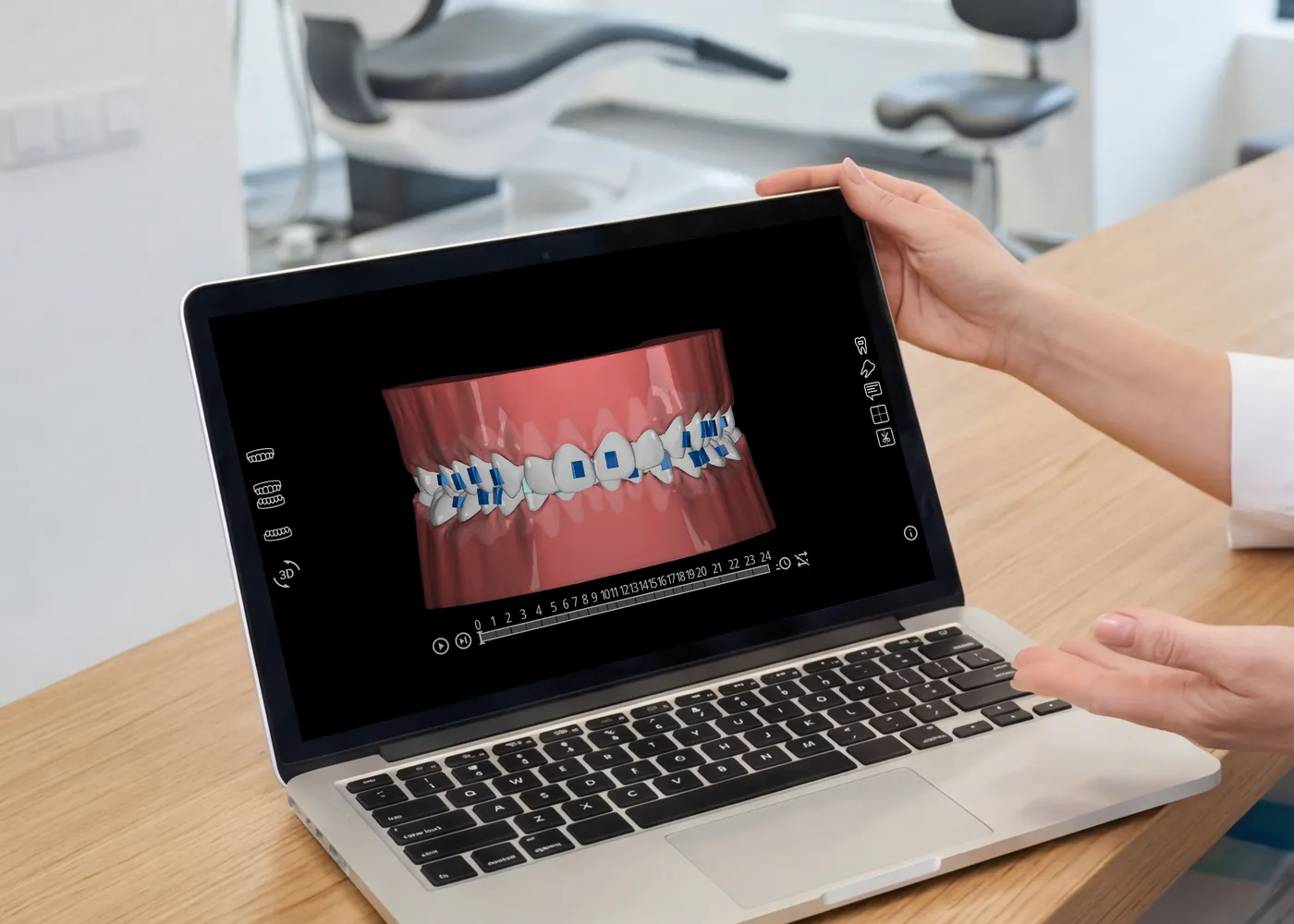 Digitális kezelési terv: a fogak tervezett elmozdulása lépésenként, laptopon