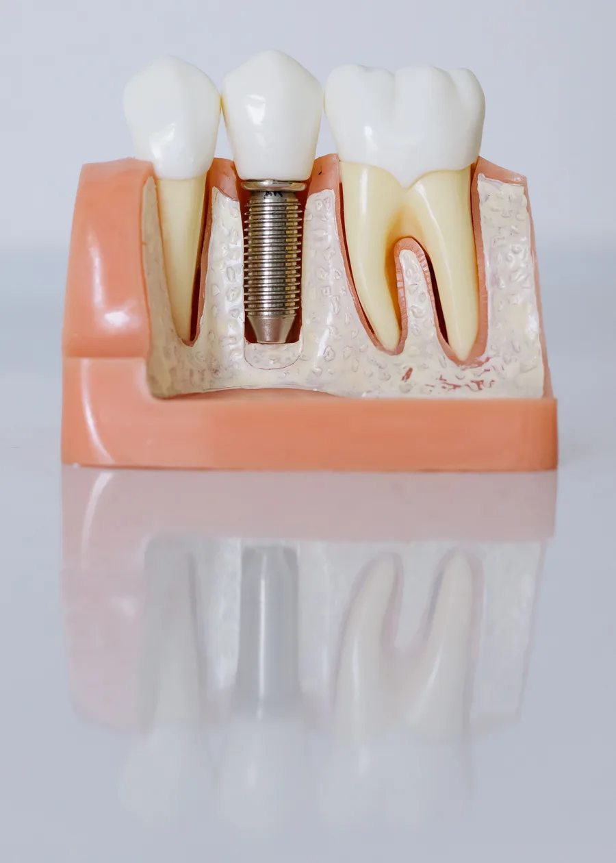 Fogászati implantátum